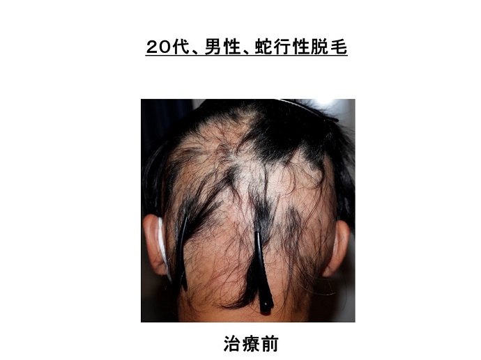 汎発性脱毛　名医
